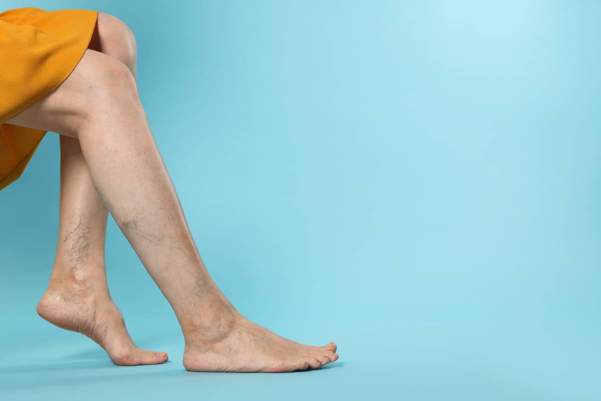 The Importance of Early Detection and Intervention in Varicose Vein Management